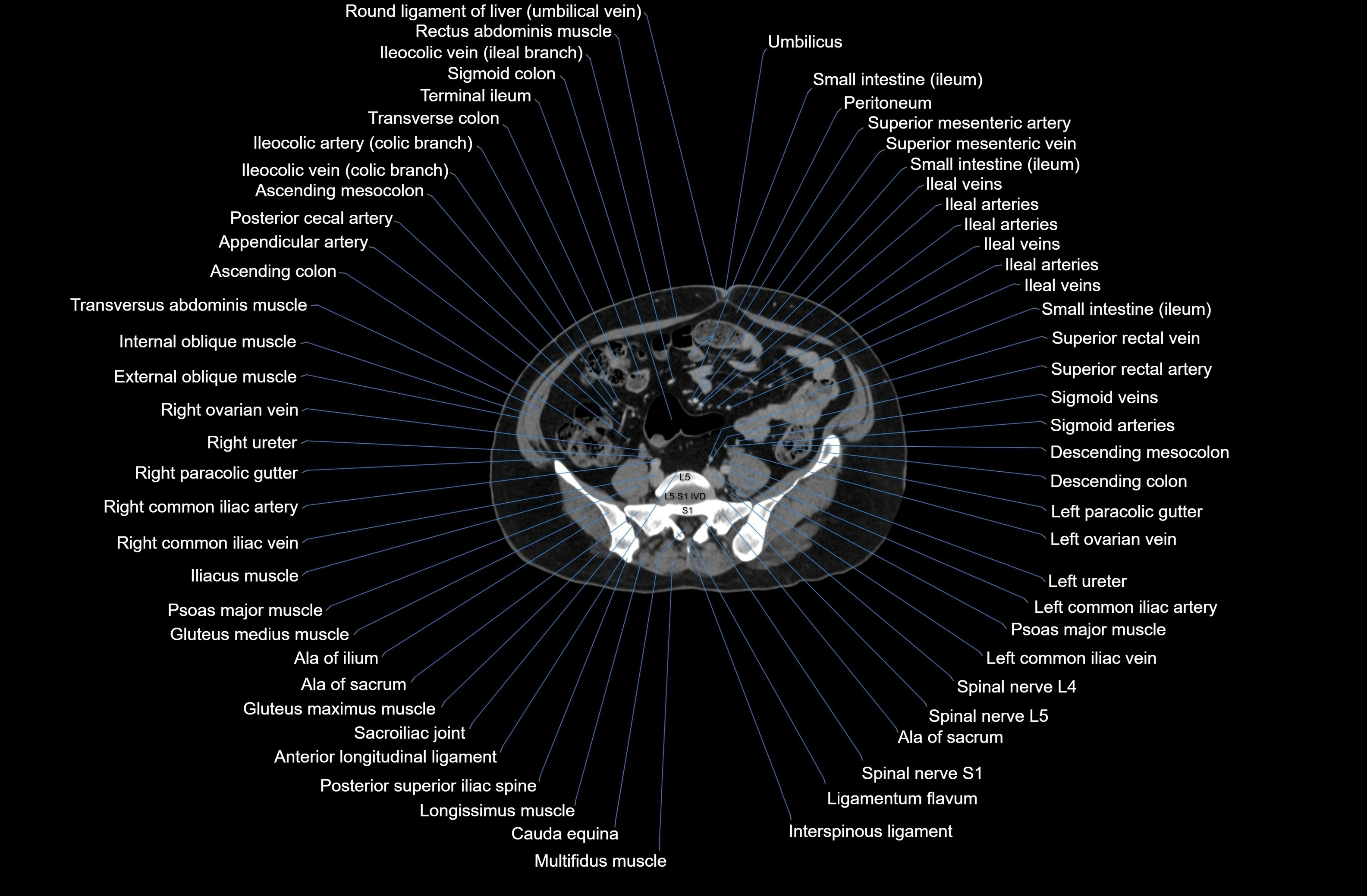 CT Abdomen axial cross sectional anatomy labelled radiology image-00063.webp